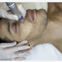 BB Glow full treatment- 1 процедура