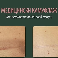 Камуфлаж на кожата