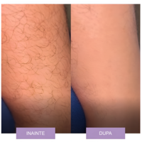 Epilator cu Cristale, pentru Epilarea de Lunga Durata, Mov, Neo™