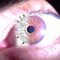 Iridologia - Consultație prin citirea irisului