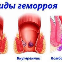 ФитоКомплекс «Лёгкость без геморроя»