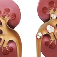 ФитоКомплекс 'Лечение почек и мочекаменной болезни'