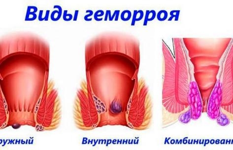 Шишка В Заднем Проходе Фото