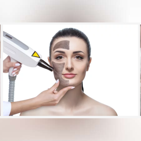 Карбонов (Холивудски) пилинг - Деколте