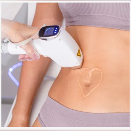 Лазерна епилация зона Цял  корем /Жени/