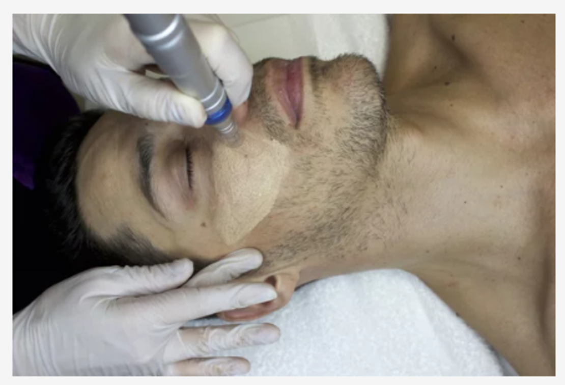 BB Glow full treatment- 1 процедура