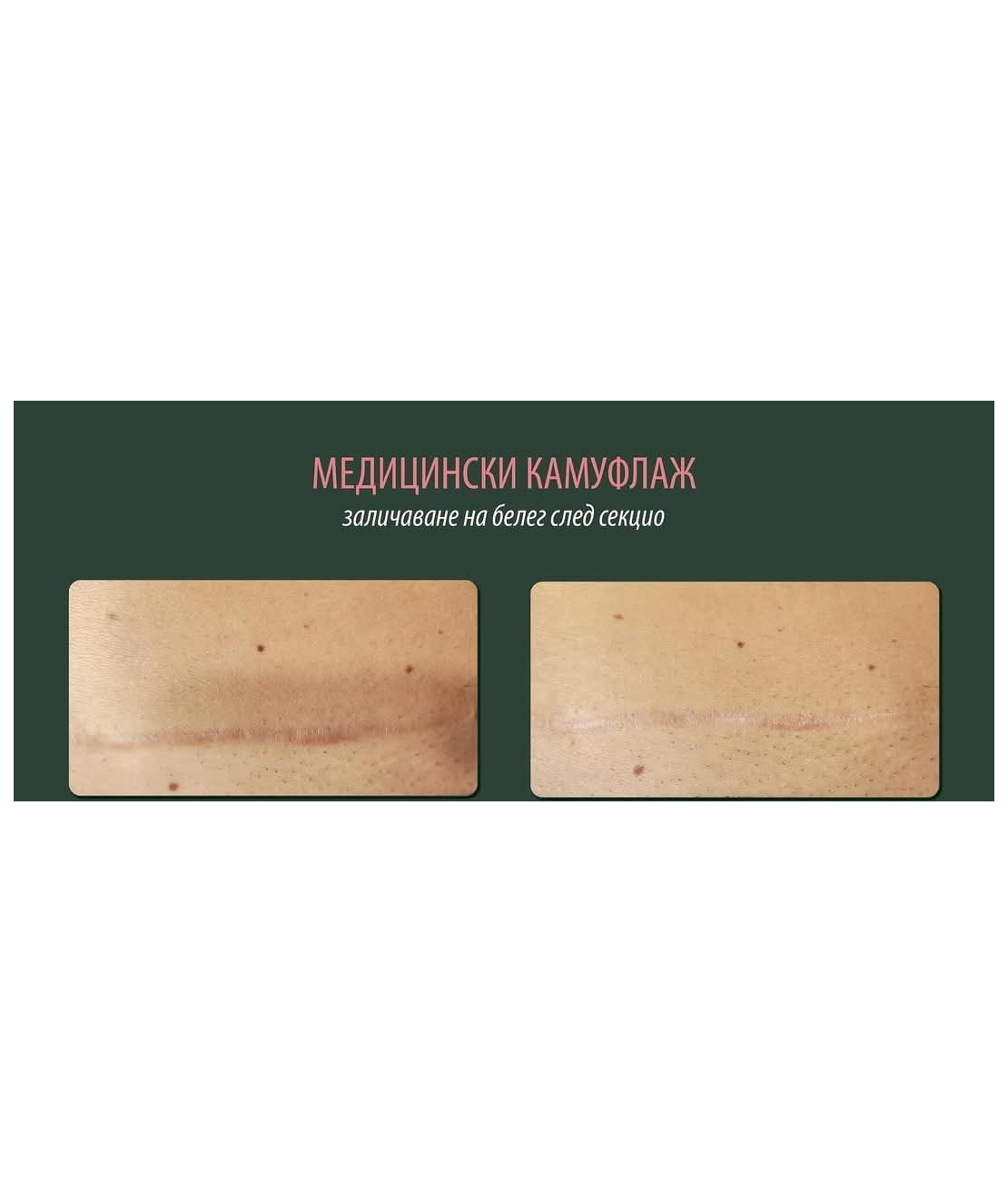 Камуфлаж на кожата