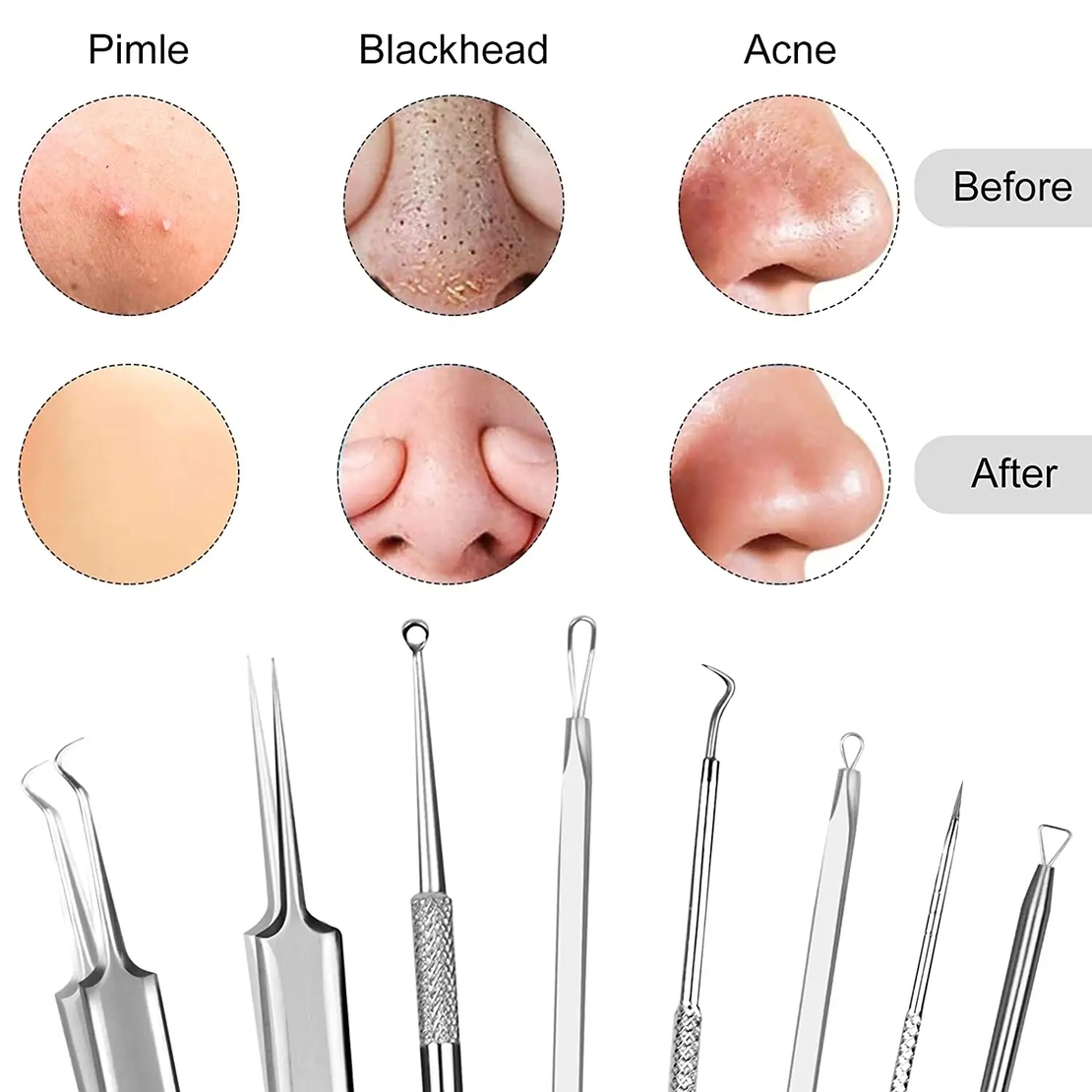Set 6 pensete pentru extractie puncte negre, comedoane, acnee, ustensile cosmetice din inox, metalic, Neo™ Premium®