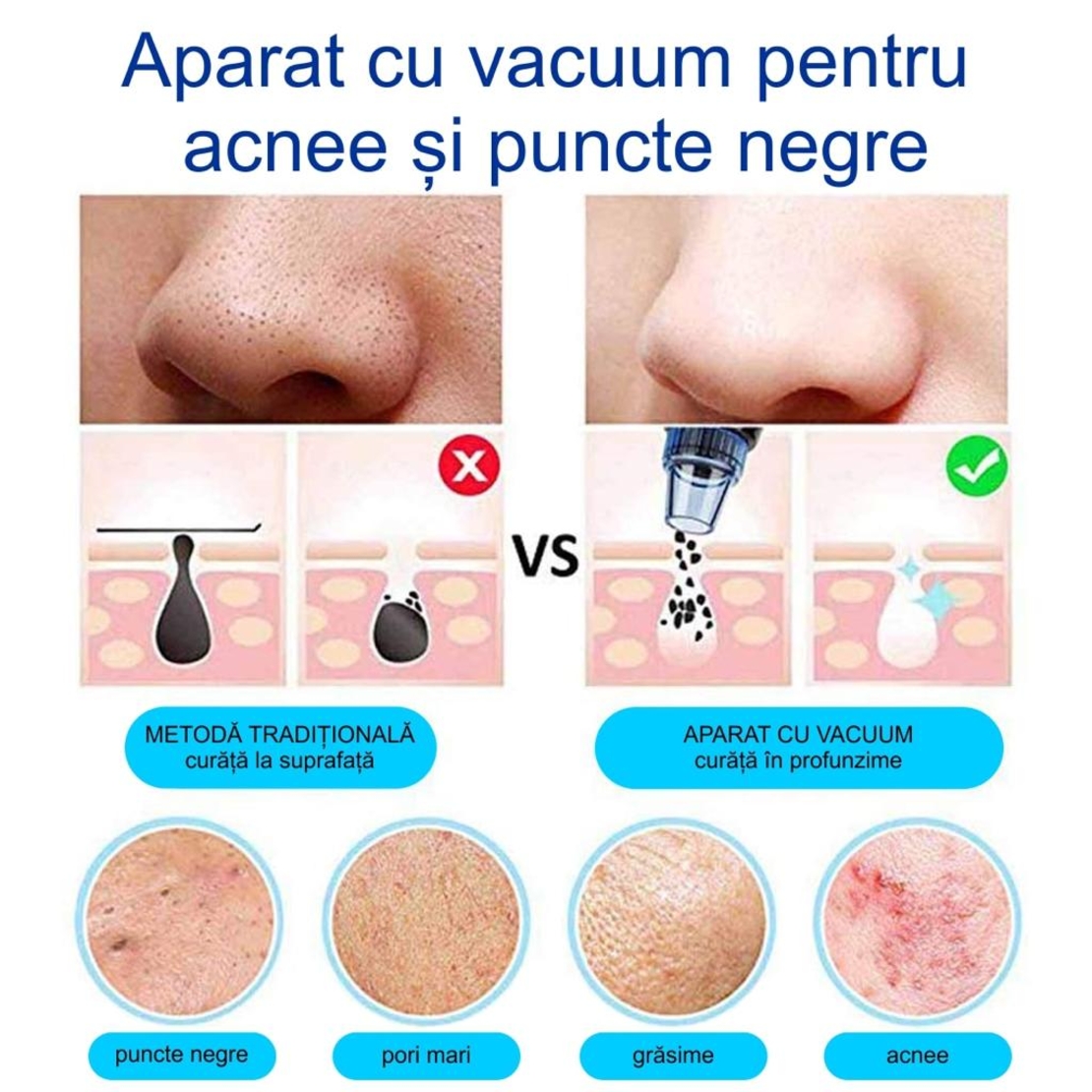 Aparat Vacuum Presure Cleaner,curatare ten,acnee,pori,puncte negre