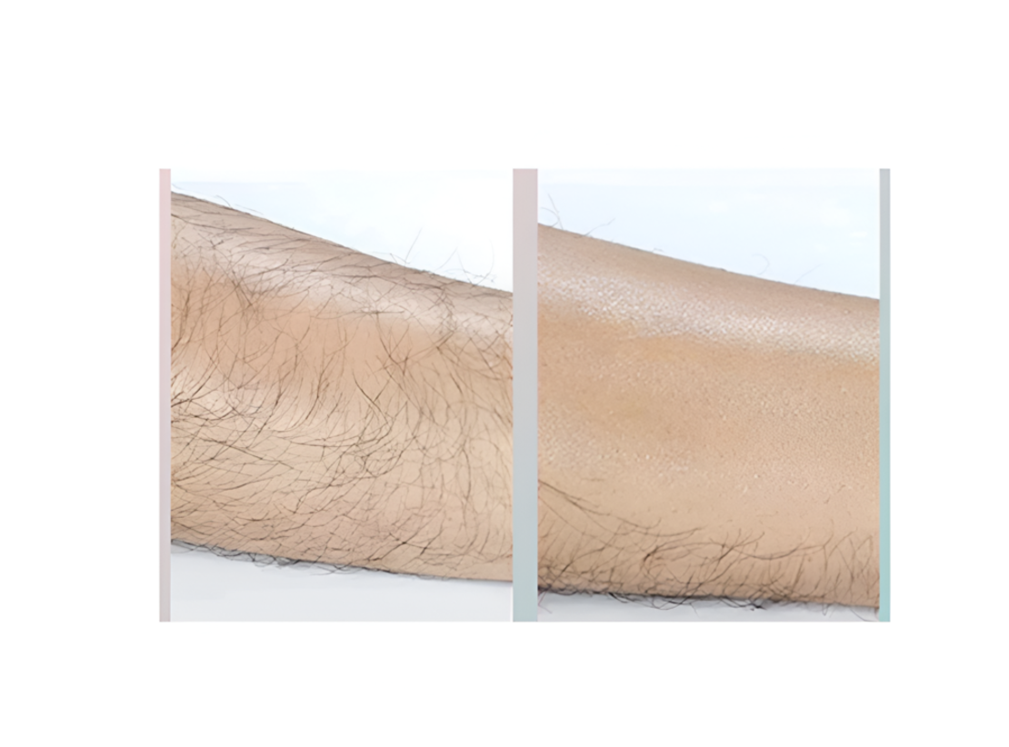 Epilator cu Cristale, pentru Epilarea de Lunga Durata, Albastru, Neo™