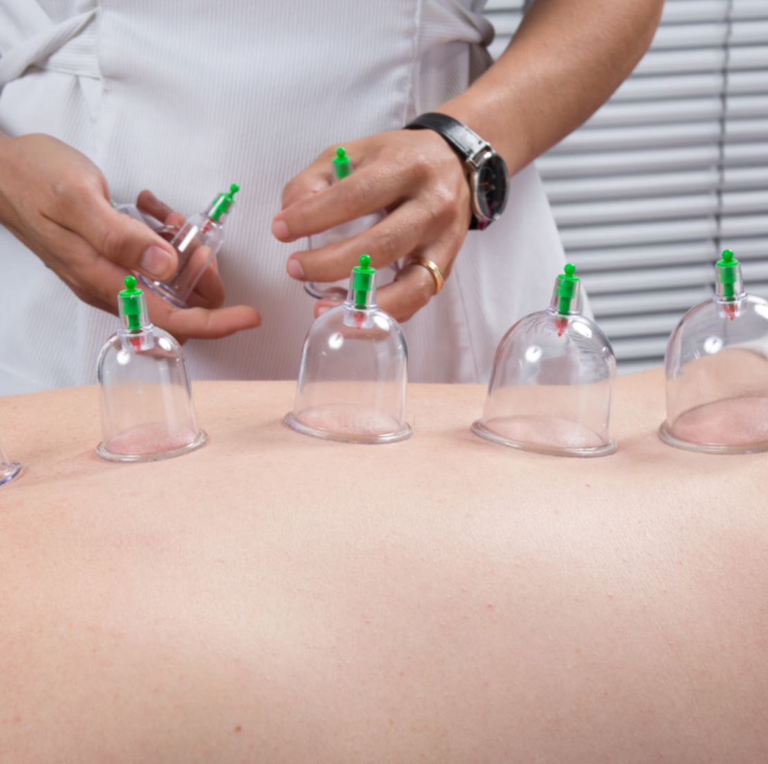 Set de 12 Ventuze Transparente pentru Masaj Terapeutic cu Pompa cu Vacuum, Efecte Anticelulitice, Antistres si Relaxare Musculara, Neo™
