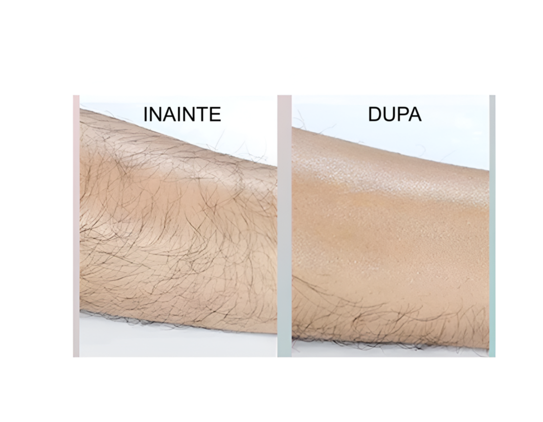 Epilator cu Cristale, pentru Epilarea de Lunga Durata, Roz, Neo™