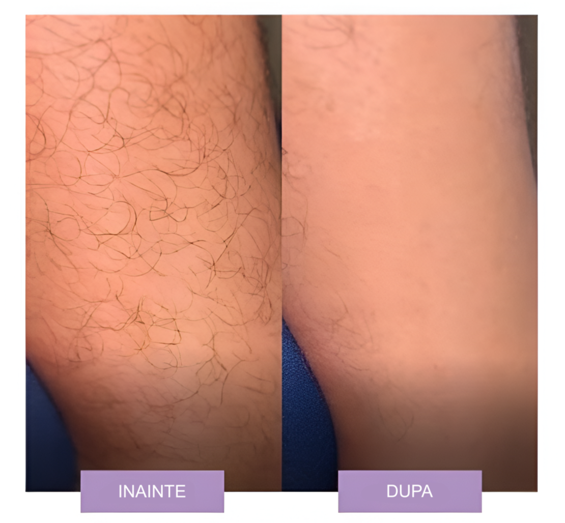 Epilator cu Cristale, pentru Epilarea de Lunga Durata, Mov, Neo™