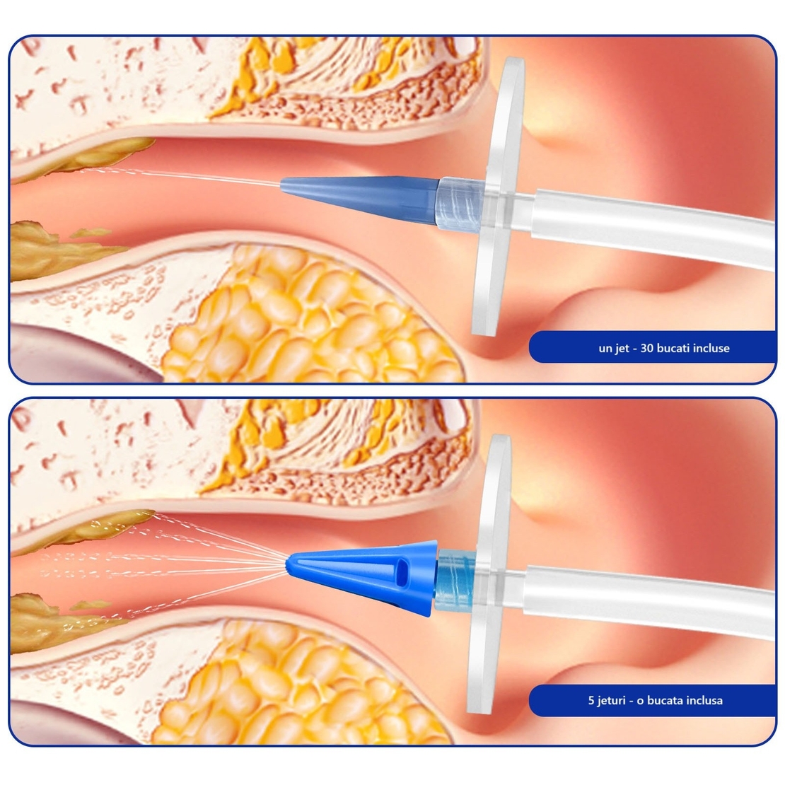 Dispozitiv de Curatare Urechi, Flippy, pentru Indepartare Ceara, Accesorii Incluse, din ABS+PC, Verde