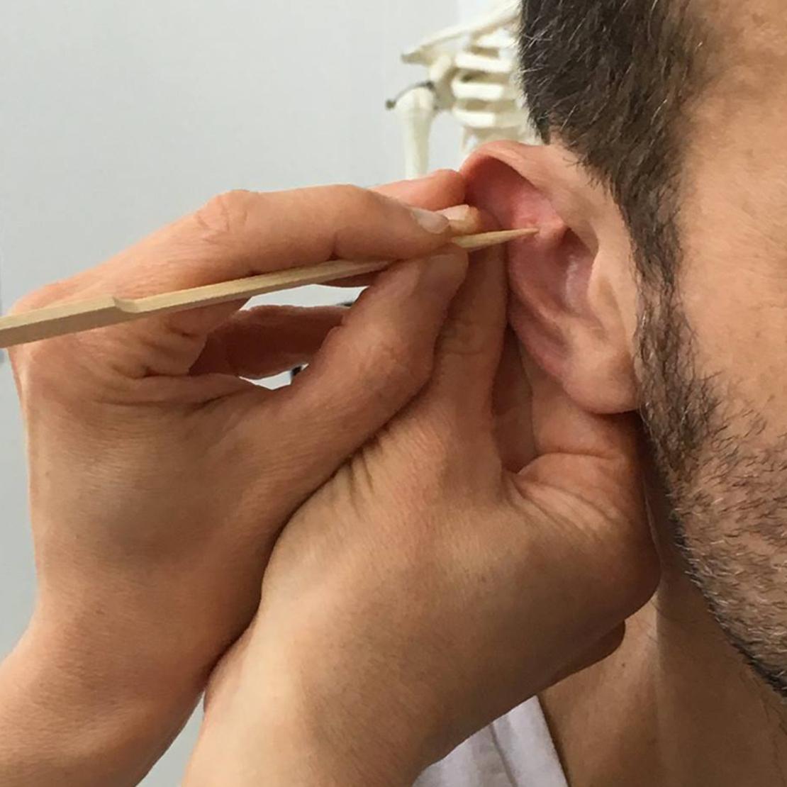 Auricoloterapie - presopunctură la lobul urechii (9+1)