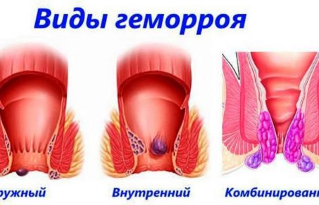 Комплекс 'Избавление от геморроя'