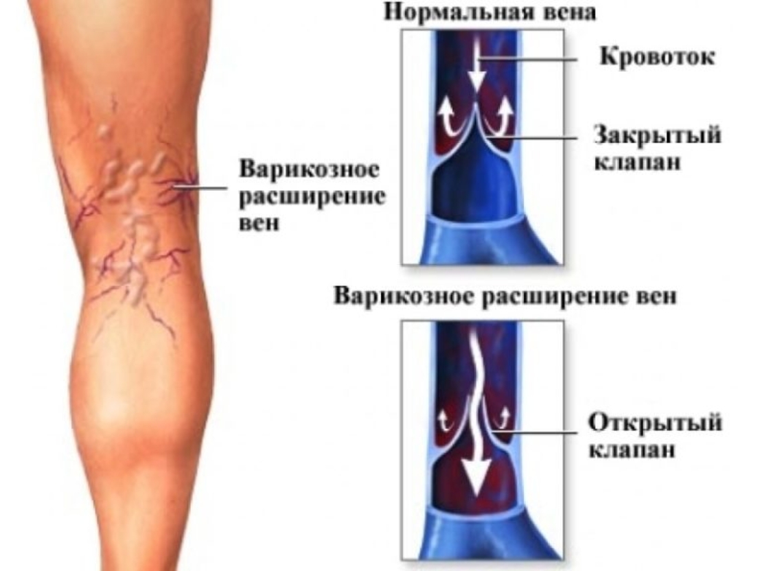 Фитокомплекс 'Легкость в ногах'